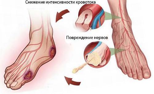 Синдром диабетической стопы3