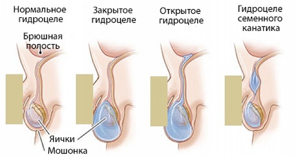 Водянка яичка у новорожденных и детей3