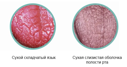 Синдром Шегрена: симптомы, диагностика, лечение3