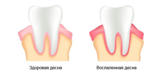 Гингивит: симптомы, лечение. Гингивит у беременных3