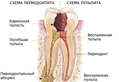 Периодонтит: симптомы, лечение3