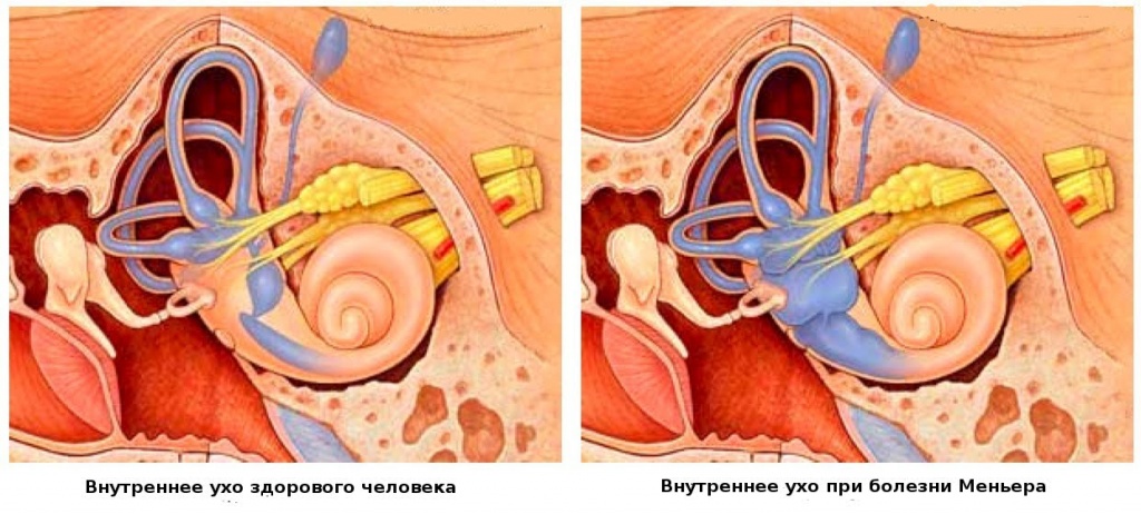 Болезнь Меньера: симптомы, лечение3