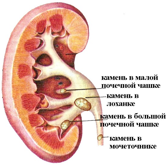 Половая жизнь при мочекаменной болезни. Лечение, последствия. 3
