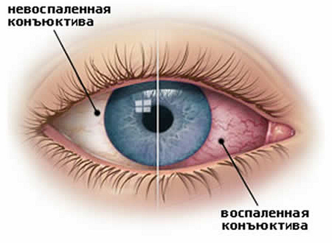 Вирусный конъюнктивит: симптомы, лечение3