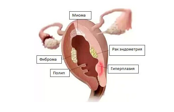 Мини-аборт: до какого срока, показания, осложнения3