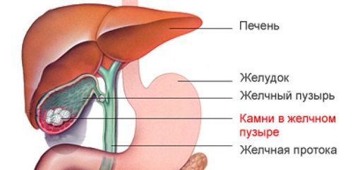 Лапароскопия желчного пузыря: показания, операция3