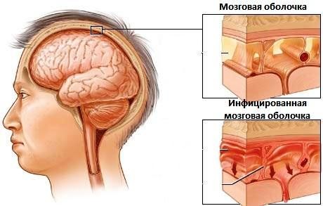 Отек головного мозга: причины, симптомы, лечение3