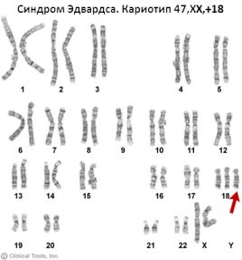 Синдром Эдвардса: причины, признаки, симптомы, лечение3