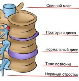 Протрузия позвоночника: причины, лечение, профилактика3