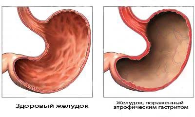 Атрофический гастрит: симптомы, диагностика, лечение3