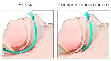 Синдром обструктивного апноэ сна3