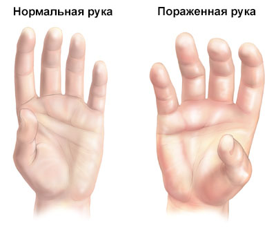 Синдром Зудека: стадии, лечение10