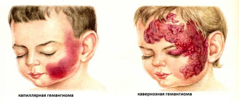 Гемангиомы: причины, виды, диагностика, лечение 3