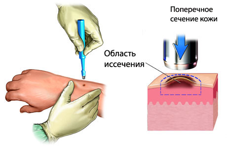 Меланома: симптомы, стадии, диагностика, прогноз3