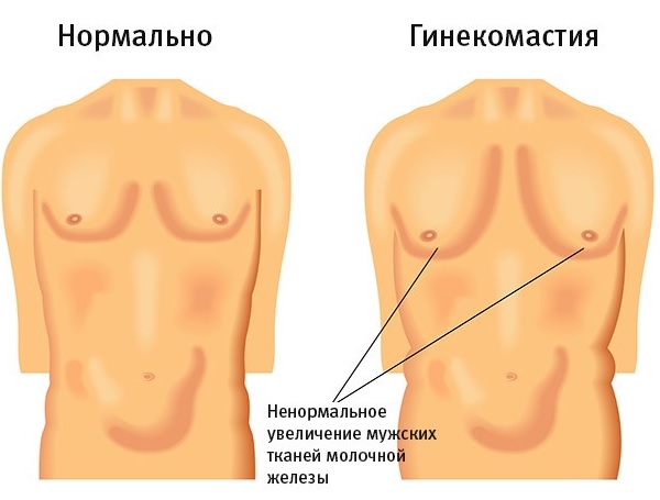 Гинекомастия: симптомы, лечение, операция3