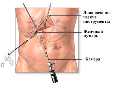 Пневмоперитонеум3