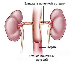 Острая почечная недостаточность3