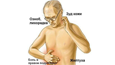 Механическая желтуха: причины, симптомы, лечение4