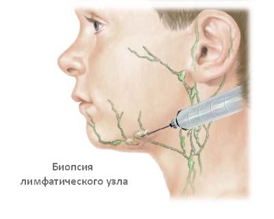 Лимфаденит4
