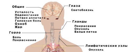Инфекционный мононуклеоз у детей4