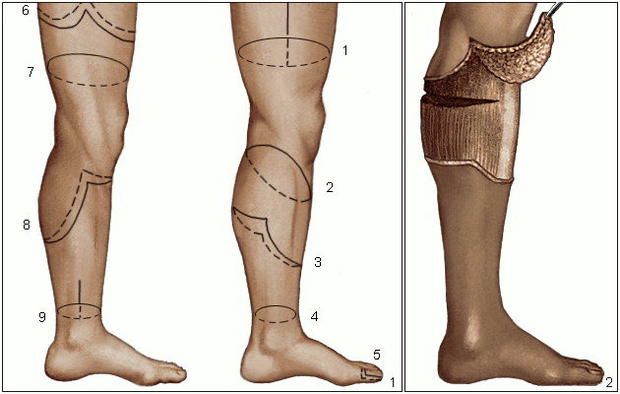 Ампутация конечностей: история, особенности4