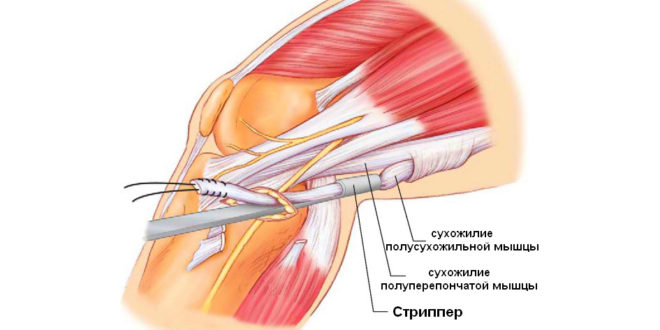 Анатомия коленного сустава4
