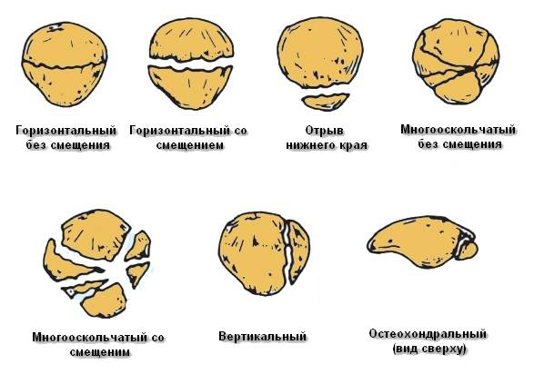 Перелом надколенника4
