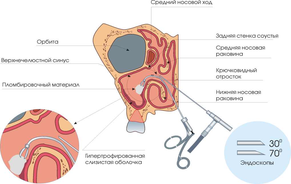 Эндоскопическая операция на пазухах носа4