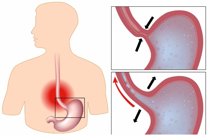 Лечение гастроэзофагеальной рефлюксной болезни4