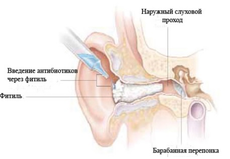 Почему болит ухо внутри4