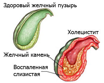 Почему болят бока под рёбрами4
