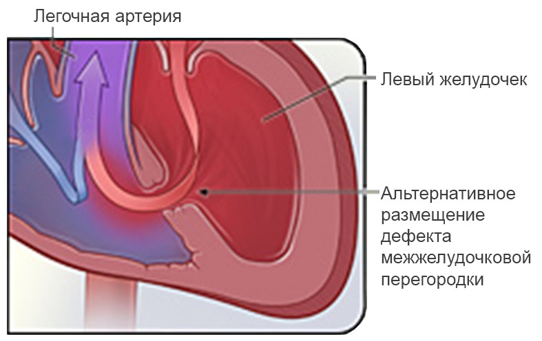 Атриовентрикулярный септальный дефект4