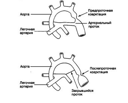 Дефект аортолегочной перегородки4