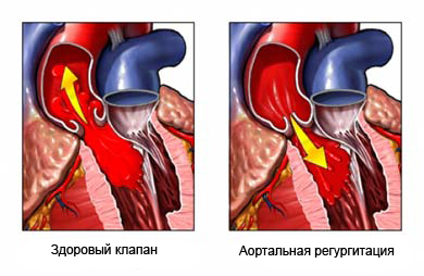 Дефект межжелудочковой перегородки4