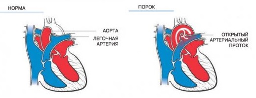 Перерыв дуги аорты у новорожденных4