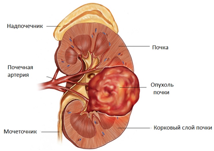 Почечная колика: симптомы, лечение4
