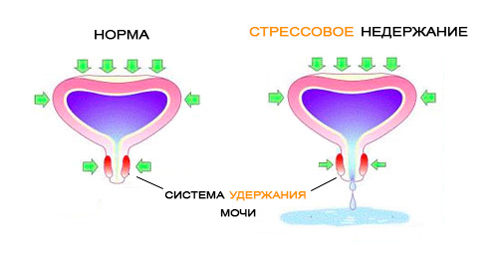 Недержание мочи у женщин: причины, симптомы, лечение2