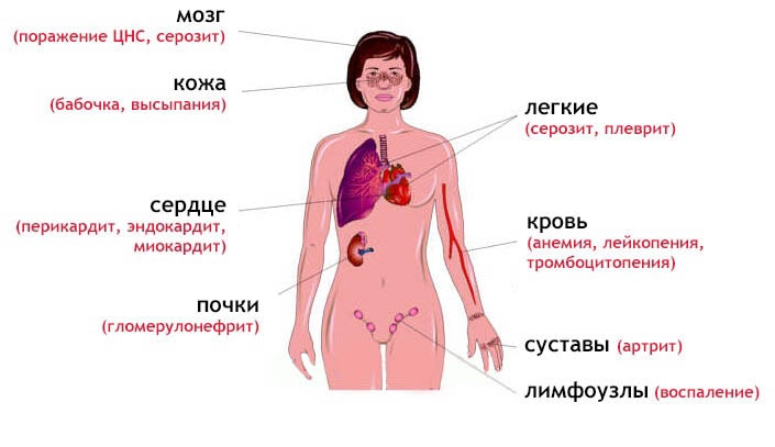 Системная красная волчанка4