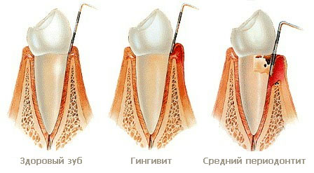 Гингивит: симптомы, лечение. Гингивит у беременных4