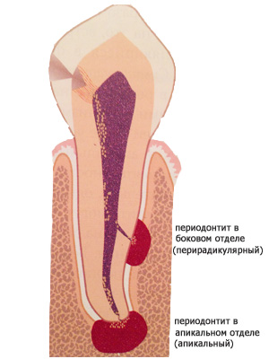 Периодонтит: симптомы, лечение4