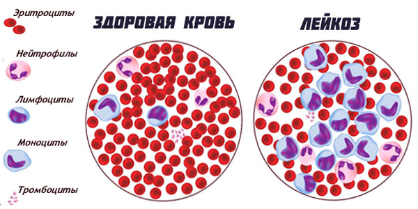 Заболевания крови у детей4