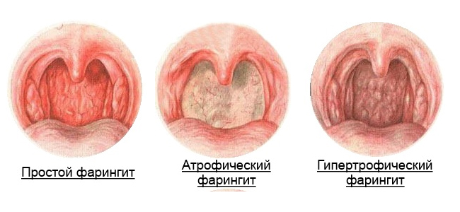 Лечение фарингита: народные средства или медикаментозное лечение4