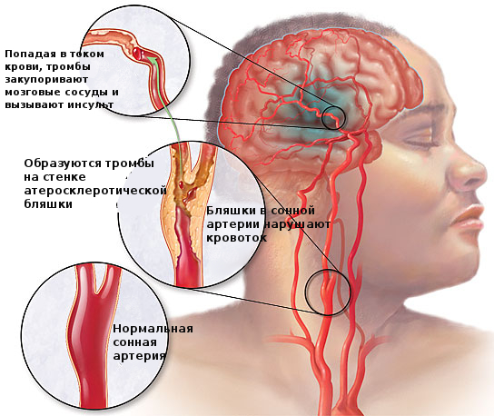 Инсульт у мужчин и женщин. Отличие, последствия.4