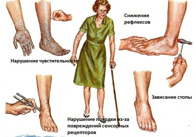 Симптомы алкогольной полинейропатии4