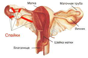 Лапароскопия маточных труб: показания, после операции4