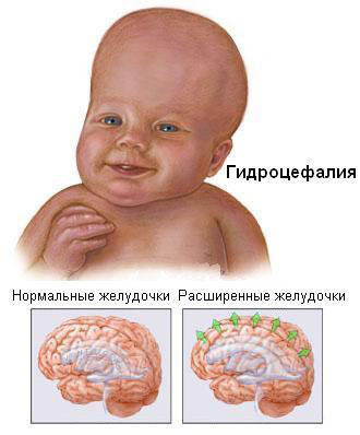 Повышенное внутричерепное давление: симптомы, лечение4