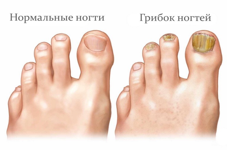 Грибок ногтей: причины, симптомы, лечение10