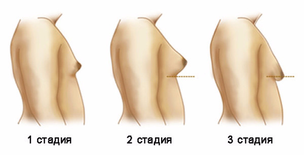 Синдром Клайнфельтера: кариотип, причины, диагностика, лечение4