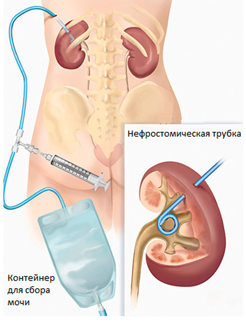 Литотрипсия в урологии. Методы литотрипсии4