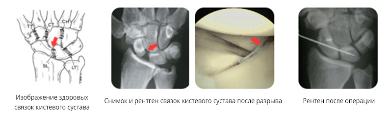Травмы лучезапястного сустава5